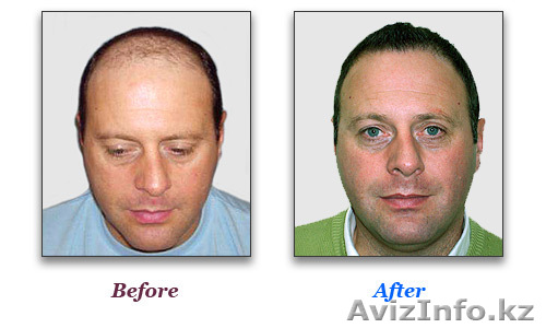 Безоперационная пересадка собственных волос - Изображение #1, Объявление #194187