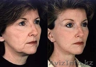 лифтинг-система,лечение угревой сыпи - Изображение #2, Объявление #586292