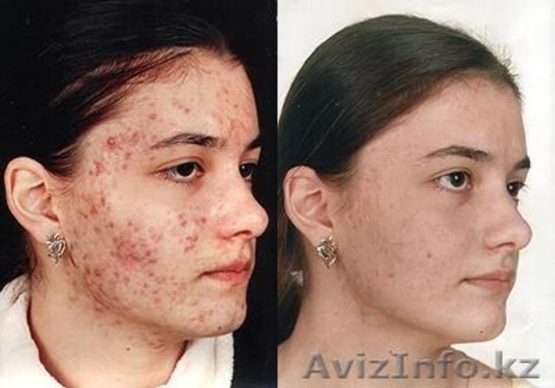 лифтинг-система,лечение угревой сыпи - Изображение #3, Объявление #586292