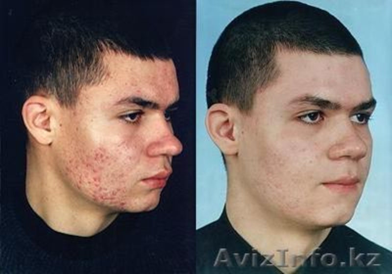 лифтинг-система,лечение угревой сыпи - Изображение #4, Объявление #586292