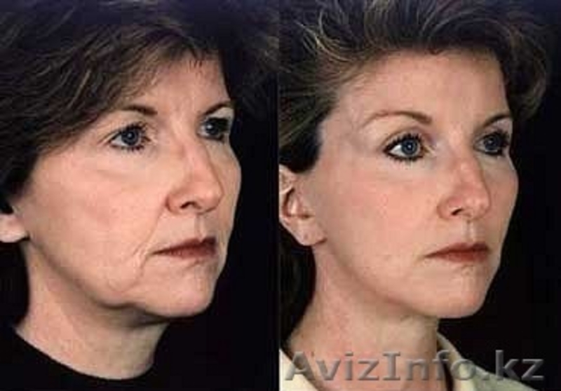 лифтинг-система,лечение угревой сыпи - Изображение #2, Объявление #586292