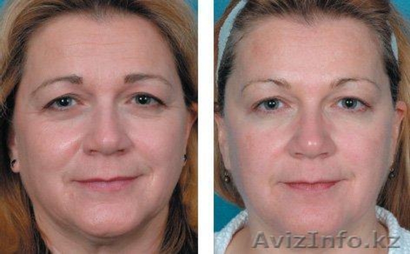 лифтинг-система,лечение угревой сыпи - Изображение #1, Объявление #586292